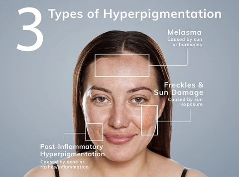 3 types of Hyperpigmentation